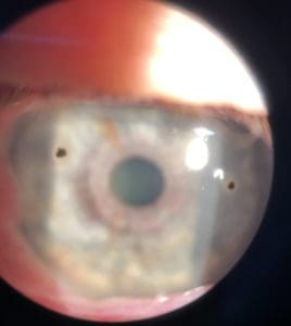 FB 2020 scaled e1600063916105 268x300 - Ever had something stuck in your eye?