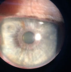 IMG 2829 scaled e1600064065436 295x300 - Ever had something stuck in your eye?